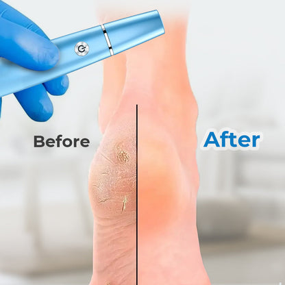 Pediluxe™ - Electric Feet Callus Remover🔥